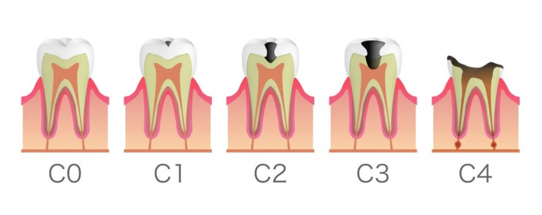 虫歯の進行段階
