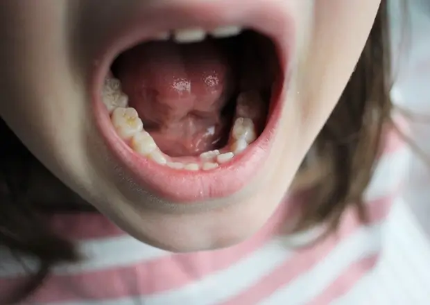 お子様のためのマウスピース矯正