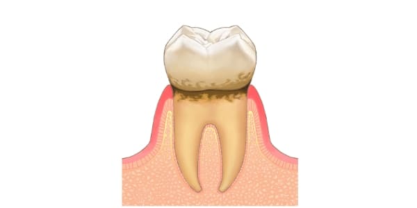 初期の歯周炎