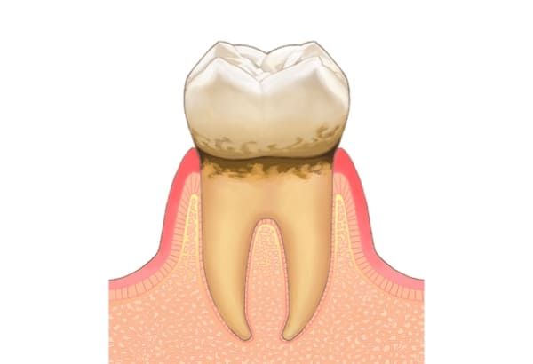 初期の歯周炎