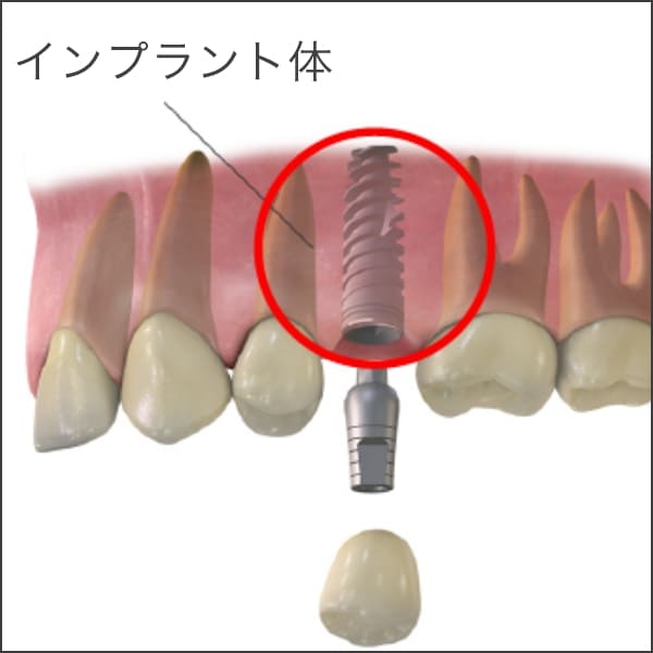 インプラント