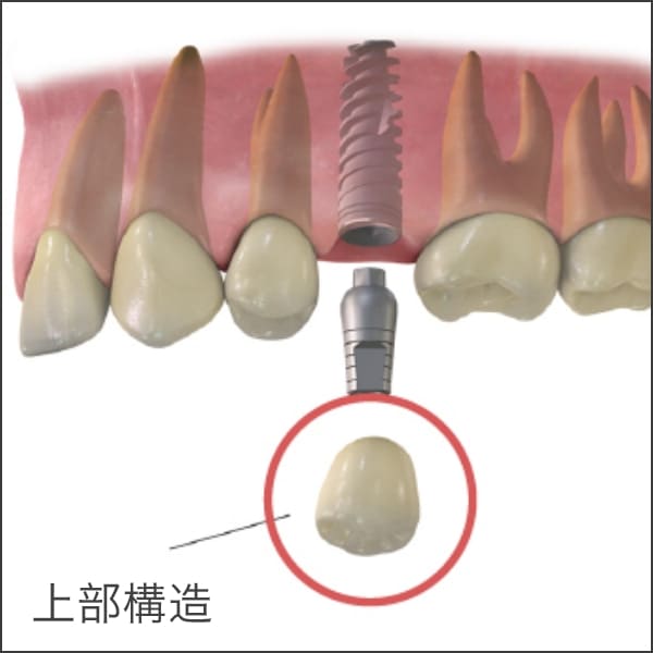 インプラント