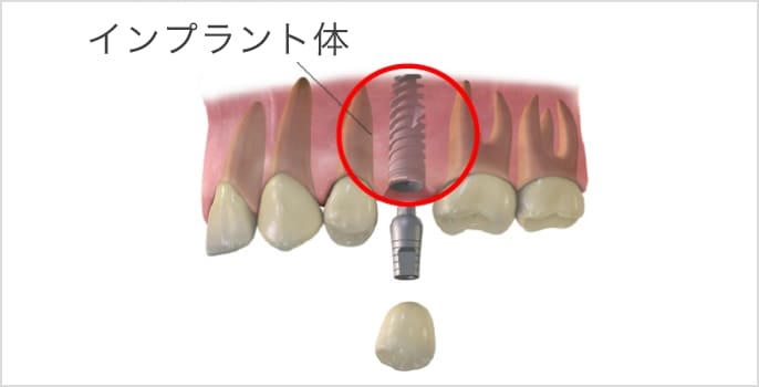インプラント